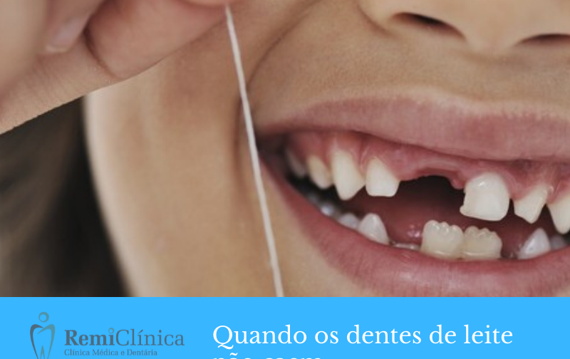 Remiclínica Clinica Médica e Dentária Quando os dentes de leite não caem Remiclínica Clinica Médica e Dentária Quando os dentes de leite não caem
