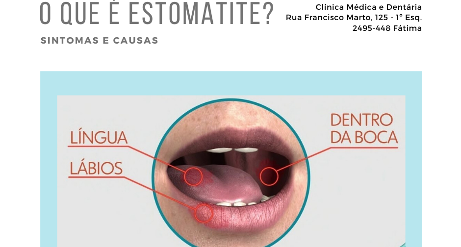 Remicl nica Clinica M dica E Dent ria O Que Estomatite 