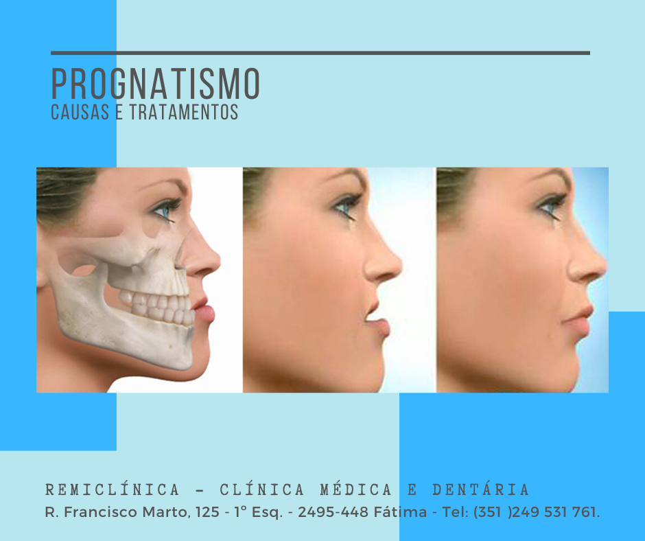 Prognatismo mandibular