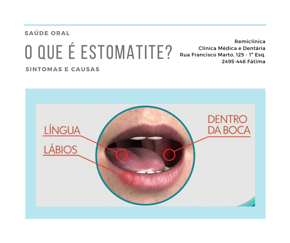 Tratamento Da Estomatite Estomatite O Que Sintomas E Tratamentos 