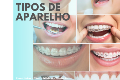 Tipos de Aparelho dentrio 