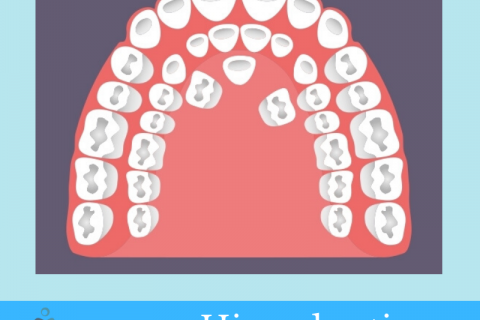 Hiperdontia 