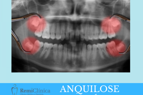 Anquilose dentria