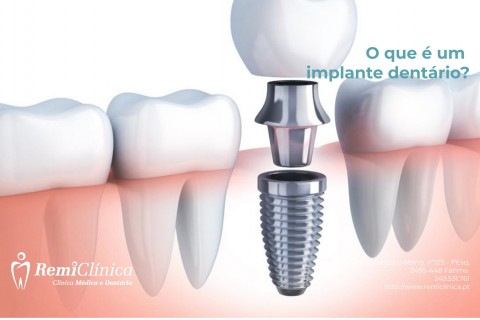 Implante dentário 