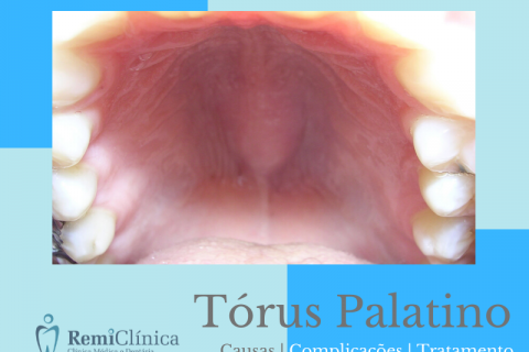 Tórus Palatino