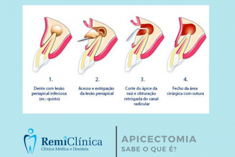 Apicectomia