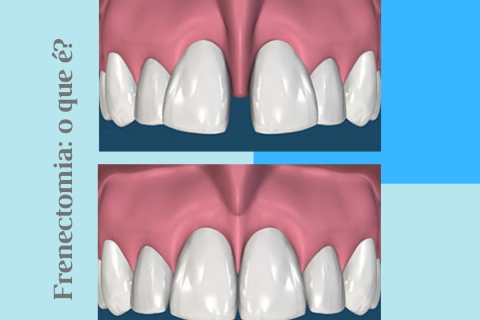 Frenectomia: o que ?