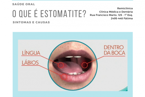 O que  estomatite?