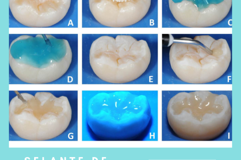 Selante de fissuras: para que serve?