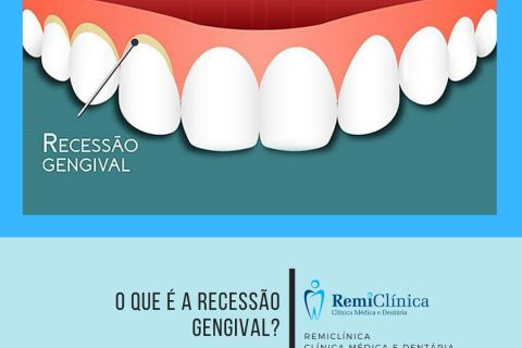 O que  a recesso gengival?